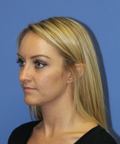 Rhinoplasty 1438 – Click HERE for more views after photo. Individual results may vary.