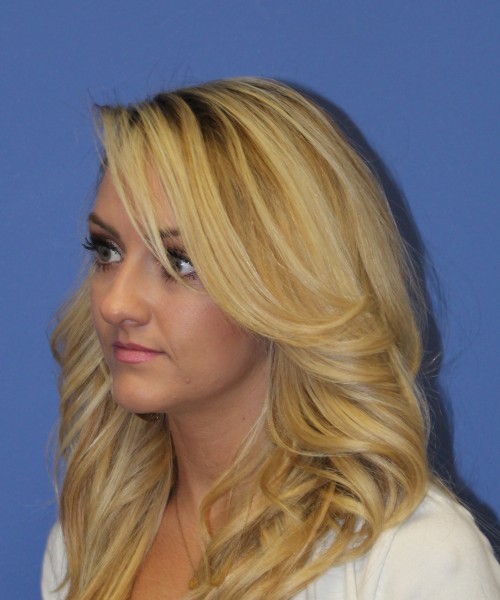 Rhinoplasty 1438 – Click HERE for more views before photo. Individual results may vary.