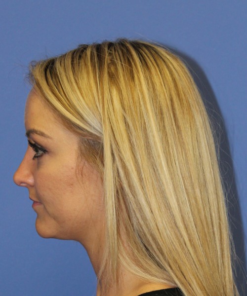 Rhinoplasty 1438 – Click HERE for more views after photo. Individual results may vary.