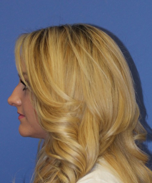 Rhinoplasty 1438 – Click HERE for more views before photo. Individual results may vary.