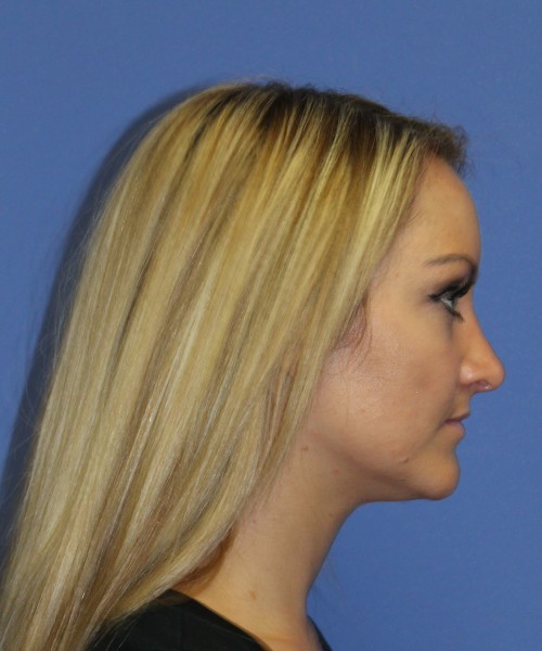 Rhinoplasty 1438 – Click HERE for more views after photo. Individual results may vary.