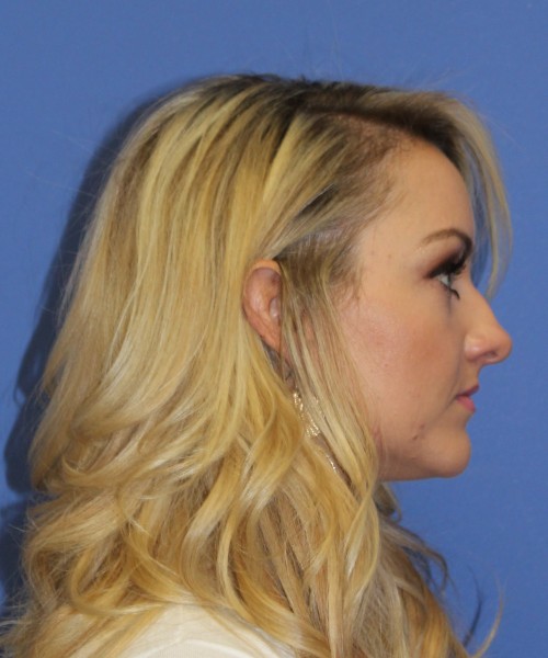 Rhinoplasty 1438 – Click HERE for more views before photo. Individual results may vary.