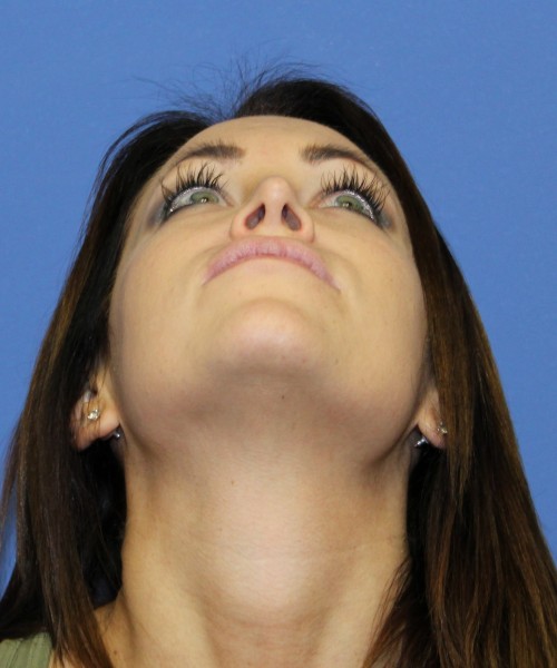 Rhinoplasty 1439 – Click HERE for more views after photo. Individual results may vary.