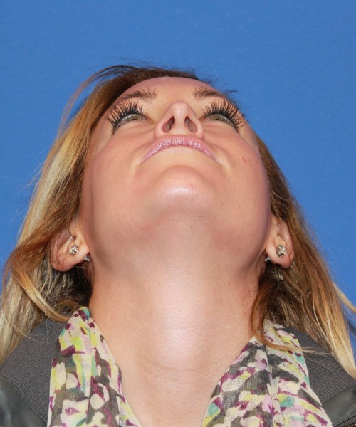 Rhinoplasty 1439 – Click HERE for more views before photo. Individual results may vary.