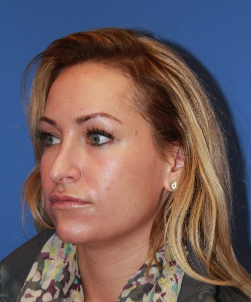 Rhinoplasty 1439 – Click HERE for more views before photo. Individual results may vary.