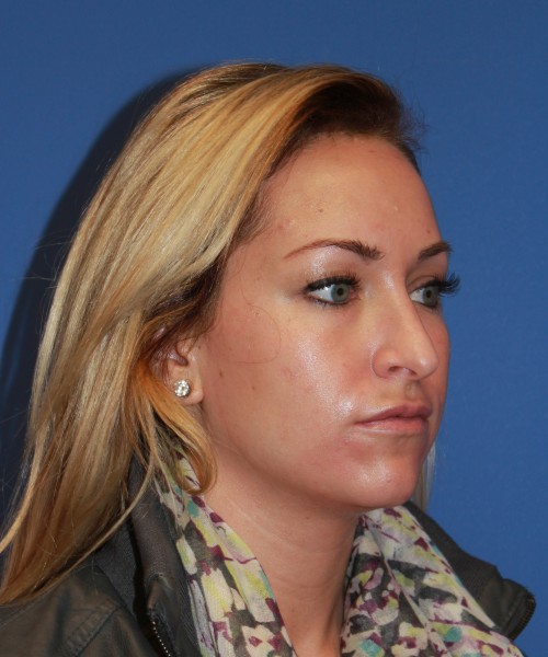 Rhinoplasty 1439 – Click HERE for more views before photo. Individual results may vary.