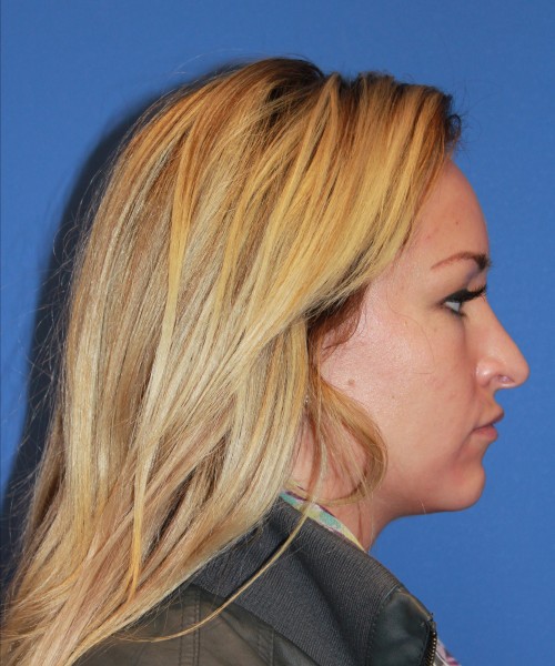 Rhinoplasty 1439 – Click HERE for more views before photo. Individual results may vary.