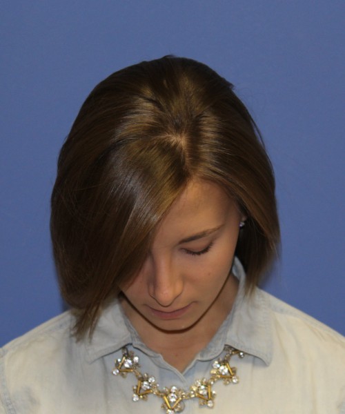Rhinoplasty 1440 – Click HERE for more views after photo. Individual results may vary.