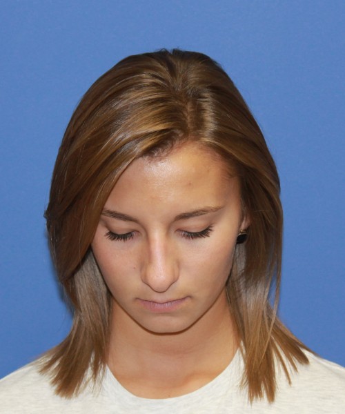Rhinoplasty 1440 – Click HERE for more views before photo. Individual results may vary.