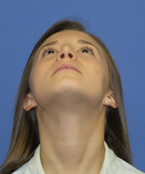 Rhinoplasty 1440 – Click HERE for more views after photo. Individual results may vary.