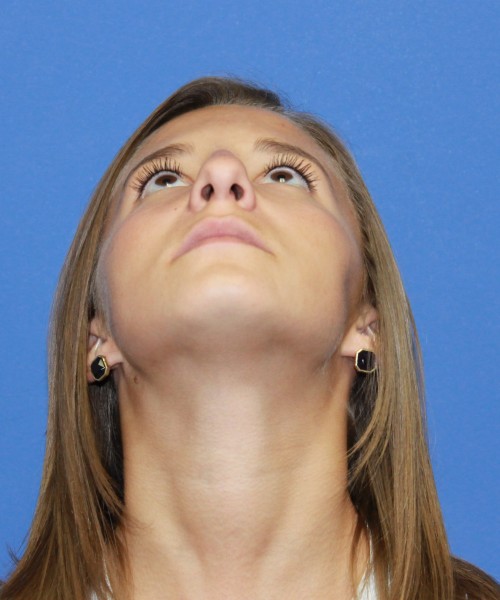 Rhinoplasty 1440 – Click HERE for more views before photo. Individual results may vary.