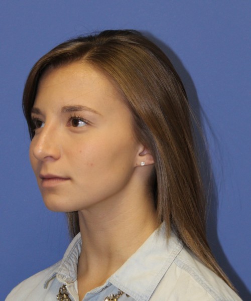 Rhinoplasty 1440 – Click HERE for more views after photo. Individual results may vary.