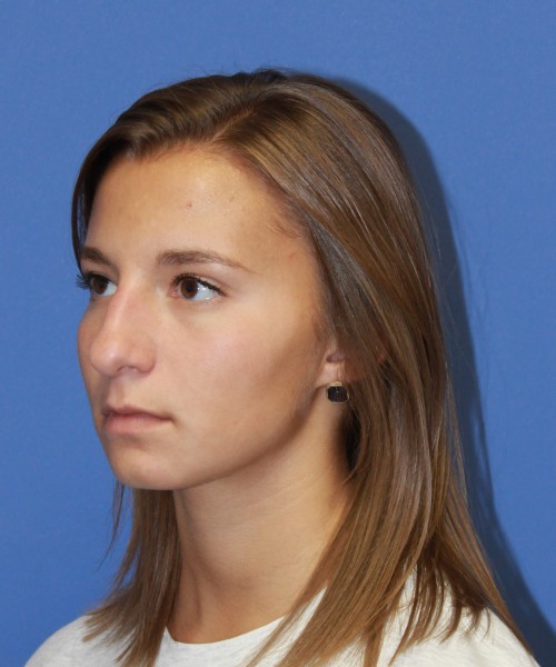 Rhinoplasty 1440 – Click HERE for more views before photo. Individual results may vary.