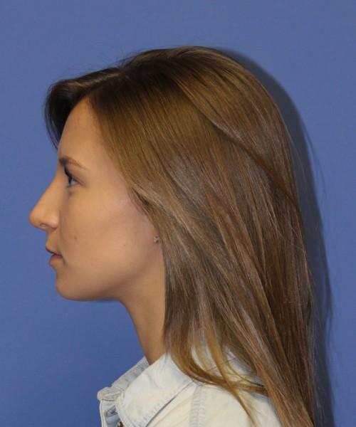 Rhinoplasty 1440 – Click HERE for more views after photo. Individual results may vary.