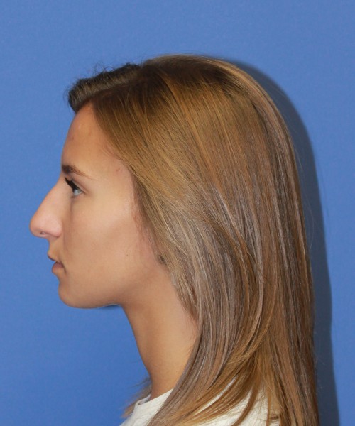 Rhinoplasty 1440 – Click HERE for more views before photo. Individual results may vary.