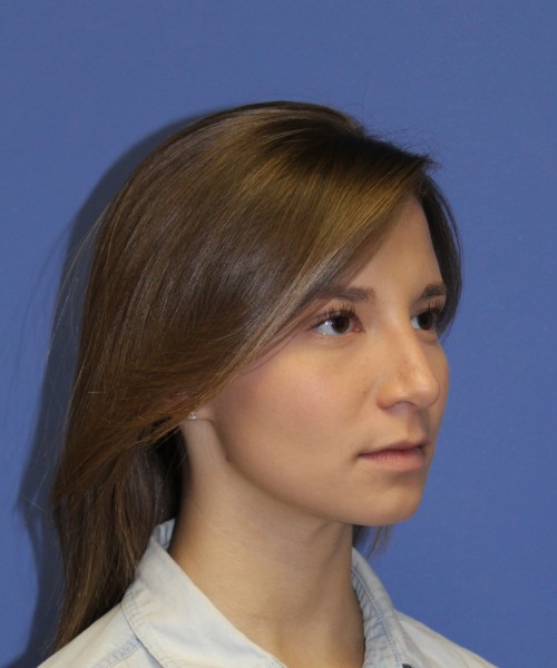 Rhinoplasty 1440 – Click HERE for more views after photo. Individual results may vary.