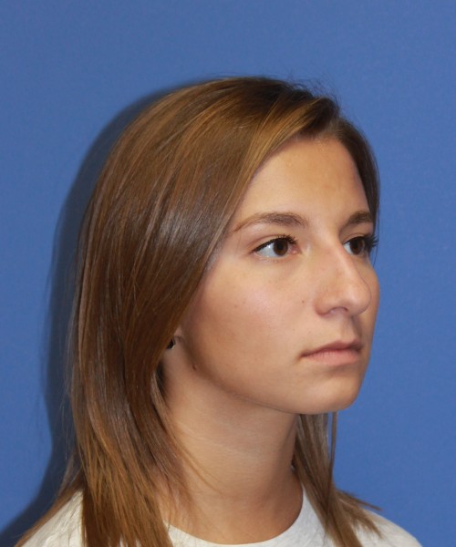 Rhinoplasty 1440 – Click HERE for more views before photo. Individual results may vary.