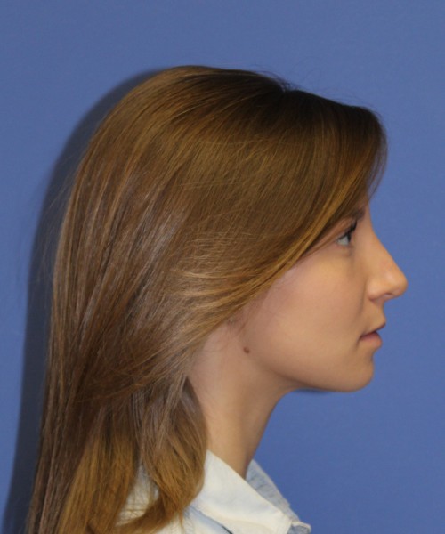 Rhinoplasty 1440 – Click HERE for more views after photo. Individual results may vary.