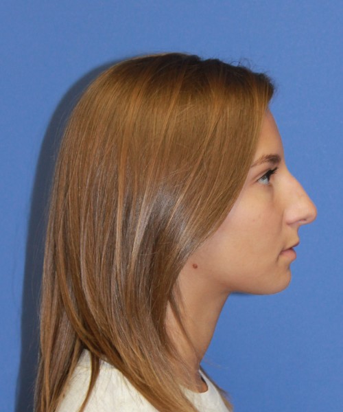 Rhinoplasty 1440 – Click HERE for more views before photo. Individual results may vary.