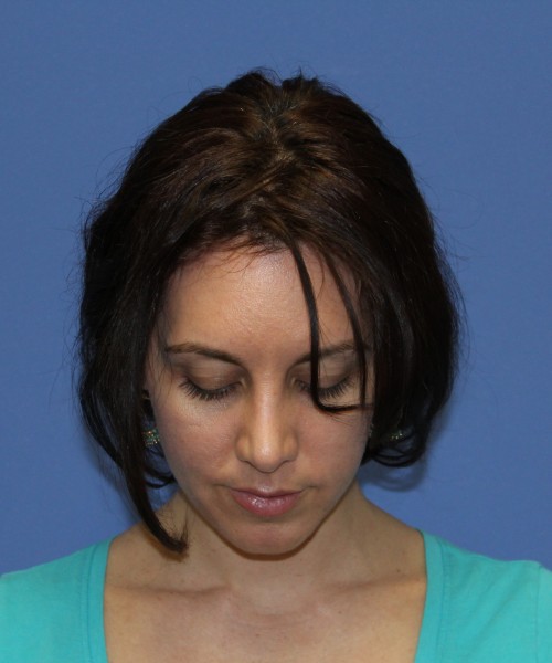 Rhinoplasty 1441 – Click HERE for more views after photo. Individual results may vary.
