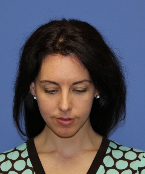 Rhinoplasty 1441 – Click HERE for more views before photo. Individual results may vary.