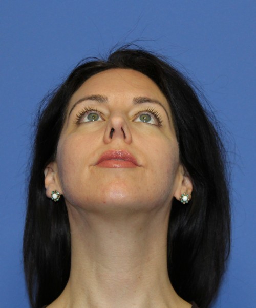 Rhinoplasty 1441 – Click HERE for more views before photo. Individual results may vary.