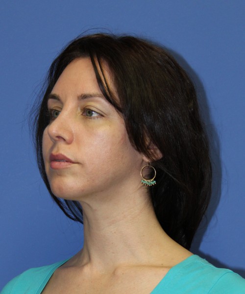 Rhinoplasty 1441 – Click HERE for more views after photo. Individual results may vary.