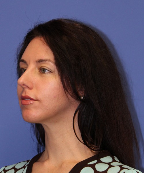 Rhinoplasty 1441 – Click HERE for more views before photo. Individual results may vary.