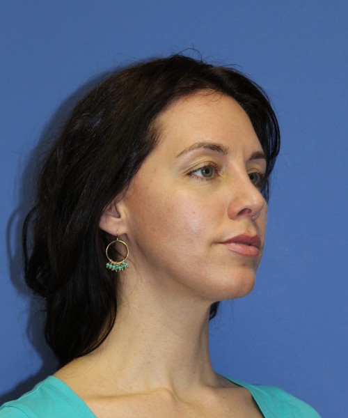 Rhinoplasty 1441 – Click HERE for more views after photo. Individual results may vary.