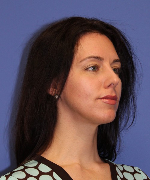 Rhinoplasty 1441 – Click HERE for more views before photo. Individual results may vary.
