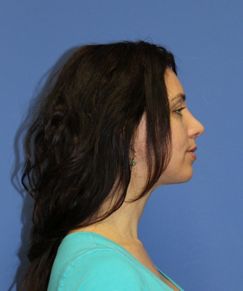 Rhinoplasty 1441 – Click HERE for more views after photo. Individual results may vary.