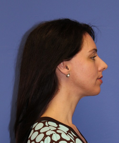 Rhinoplasty 1441 – Click HERE for more views before photo. Individual results may vary.