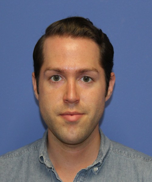 Rhinoplasty 1442 – Click HERE for more views after photo. Individual results may vary.