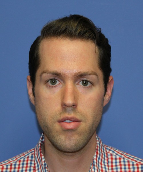 Rhinoplasty 1442 – Click HERE for more views before photo. Individual results may vary.