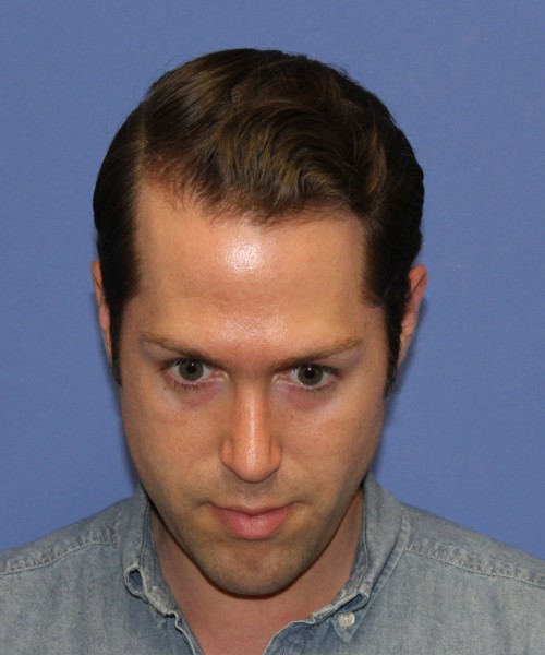 Rhinoplasty 1442 – Click HERE for more views after photo. Individual results may vary.