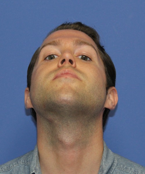 Rhinoplasty 1442 – Click HERE for more views after photo. Individual results may vary.