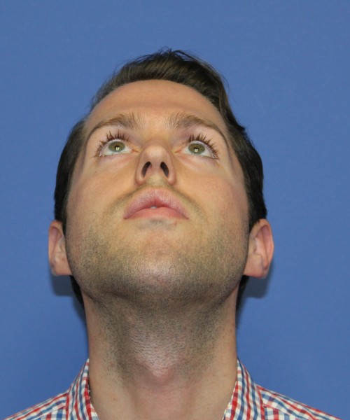 Rhinoplasty 1442 – Click HERE for more views before photo. Individual results may vary.
