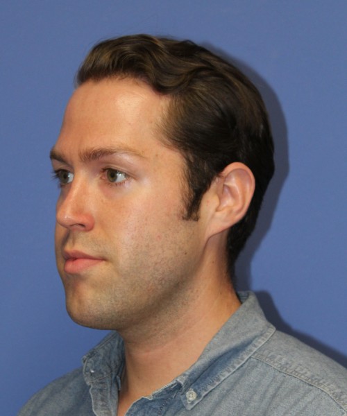 Rhinoplasty 1442 – Click HERE for more views after photo. Individual results may vary.