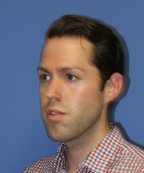Rhinoplasty 1442 – Click HERE for more views before photo. Individual results may vary.