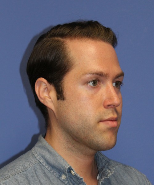 Rhinoplasty 1442 – Click HERE for more views after photo. Individual results may vary.