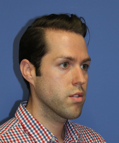 Rhinoplasty 1442 – Click HERE for more views before photo. Individual results may vary.