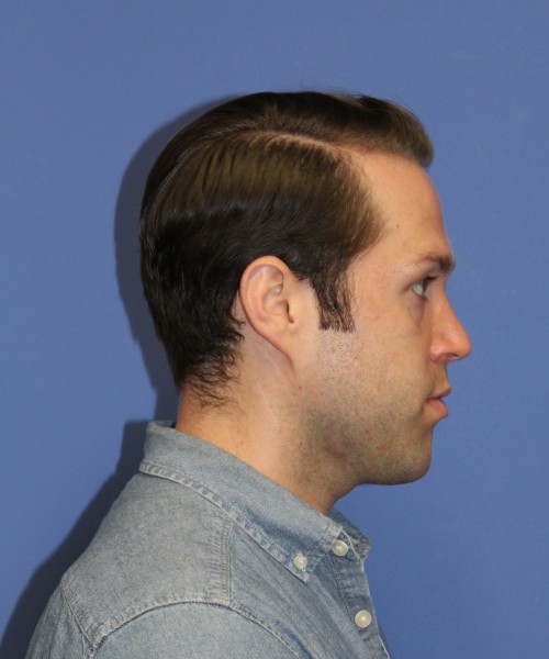 Rhinoplasty 1442 – Click HERE for more views after photo. Individual results may vary.