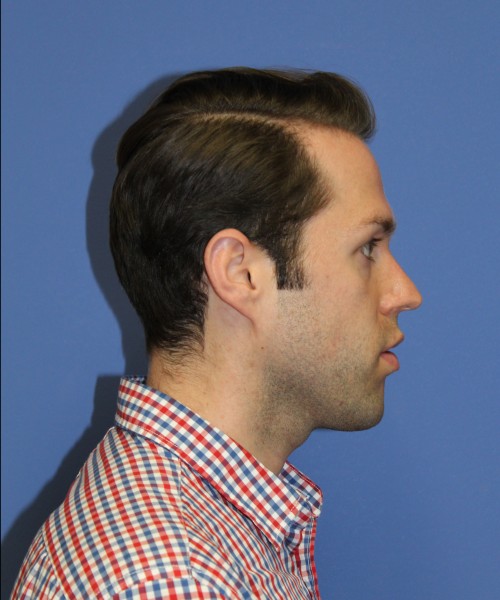 Rhinoplasty 1442 – Click HERE for more views before photo. Individual results may vary.