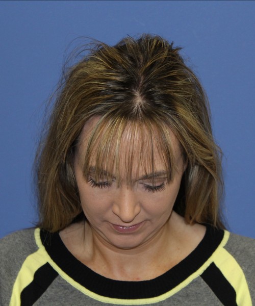 Rhinoplasty 1443 – Click HERE for more views after photo. Individual results may vary.