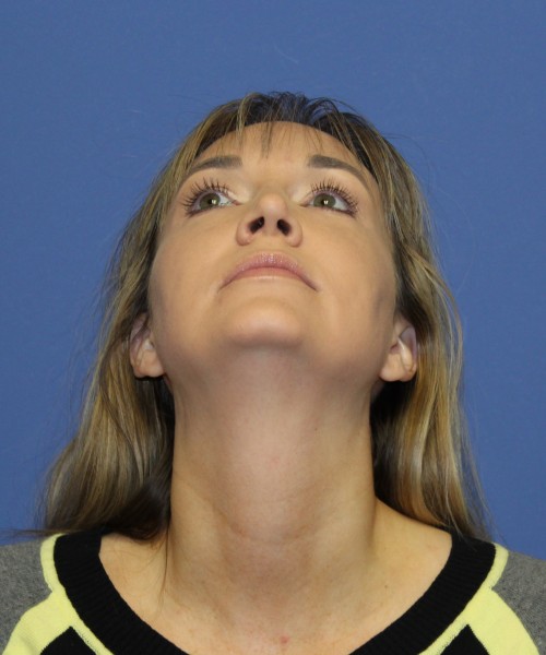 Rhinoplasty 1443 – Click HERE for more views after photo. Individual results may vary.