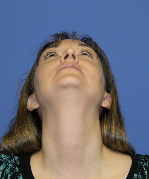 Rhinoplasty 1443 – Click HERE for more views before photo. Individual results may vary.