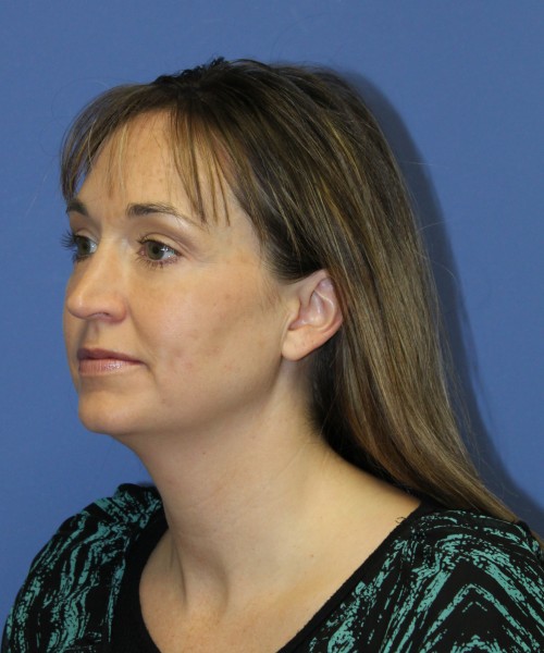 Rhinoplasty 1443 – Click HERE for more views before photo. Individual results may vary.
