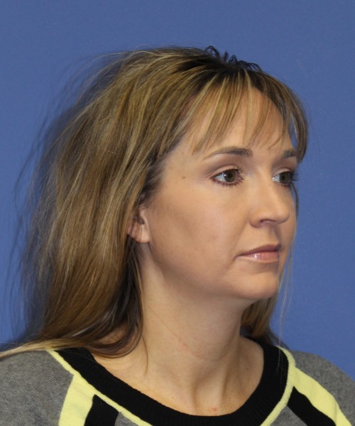 Rhinoplasty 1443 – Click HERE for more views after photo. Individual results may vary.
