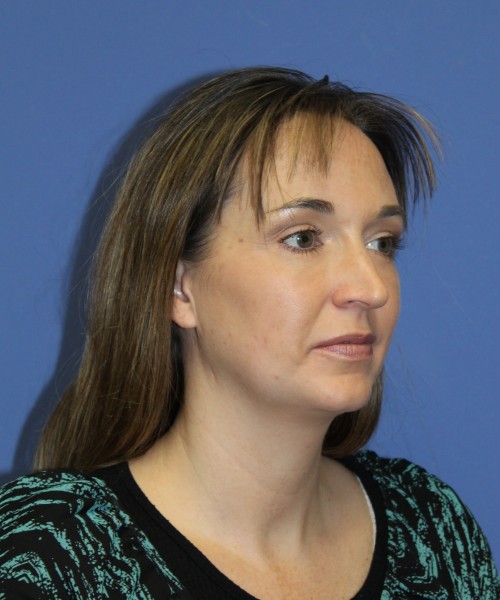 Rhinoplasty 1443 – Click HERE for more views before photo. Individual results may vary.