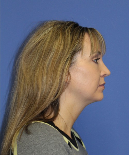 Rhinoplasty 1443 – Click HERE for more views after photo. Individual results may vary.